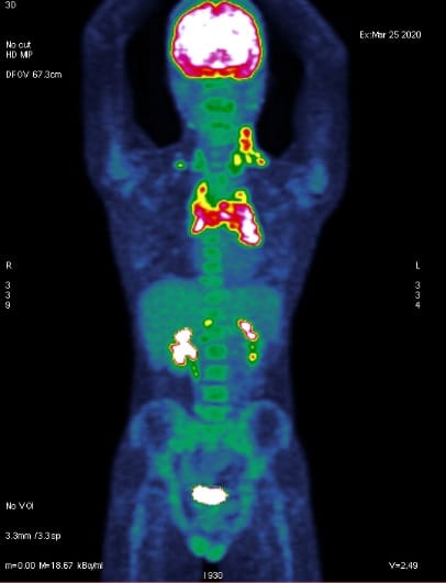 Ja ouviu falar no PET-SCAN ou PET-CT?