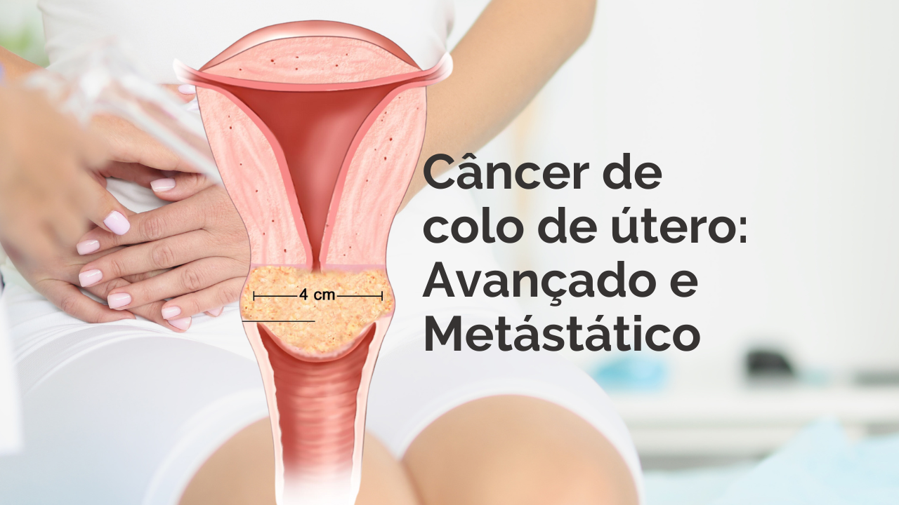 Tratamento para Câncer de Colo de Útero Localmente Avançado e Metastático