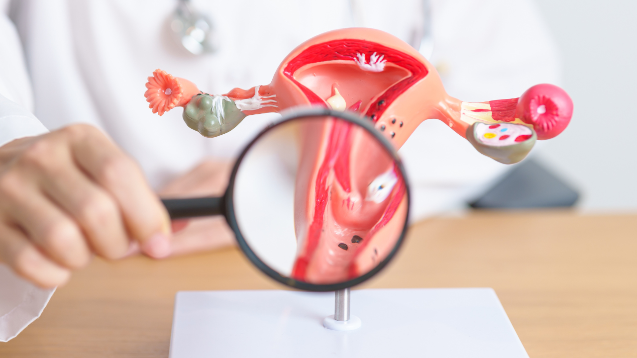 Epidemiologia do Câncer de Colo de Útero no Brasil: Entendendo os Principais Fatores de Risco