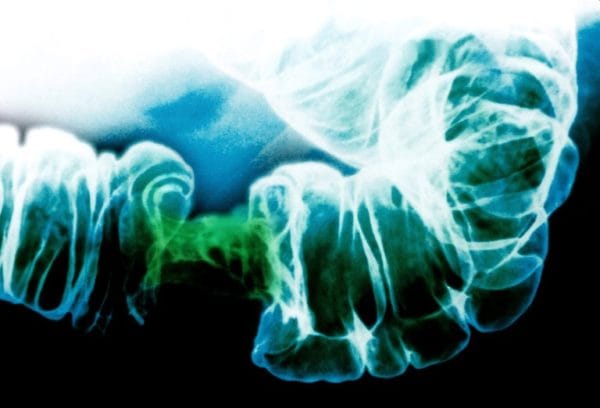 Rx com estreitamento do intestino devido a câncer de intestino