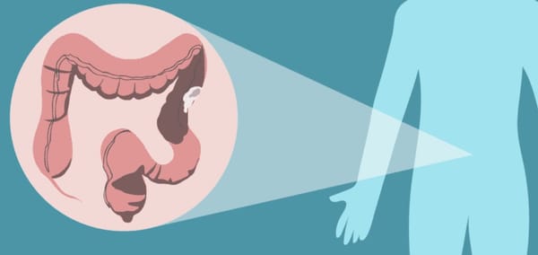 Quando devo iniciar meu rastreio do câncer de intestino?