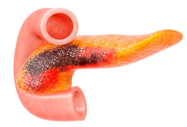 Câncer de Pâncreas