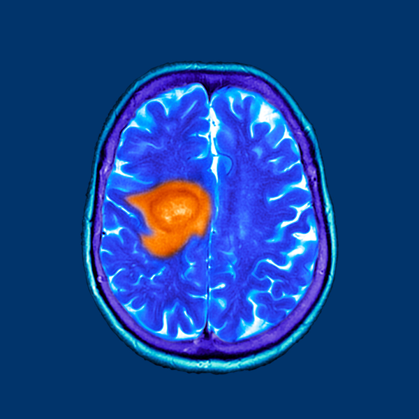 Glioblastoma: Uma Abordagem Abrangente sobre uma Doença Desafiadora